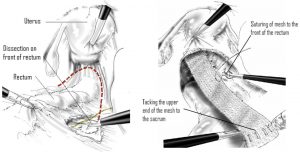 Diagram showing dissection between rectum and vagina, and positioning of mesh