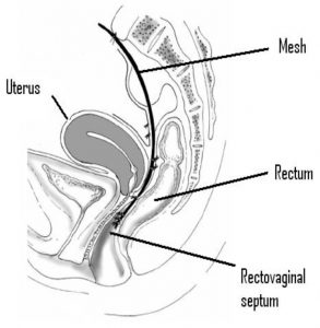 Diagram showing mesh in position after surgery