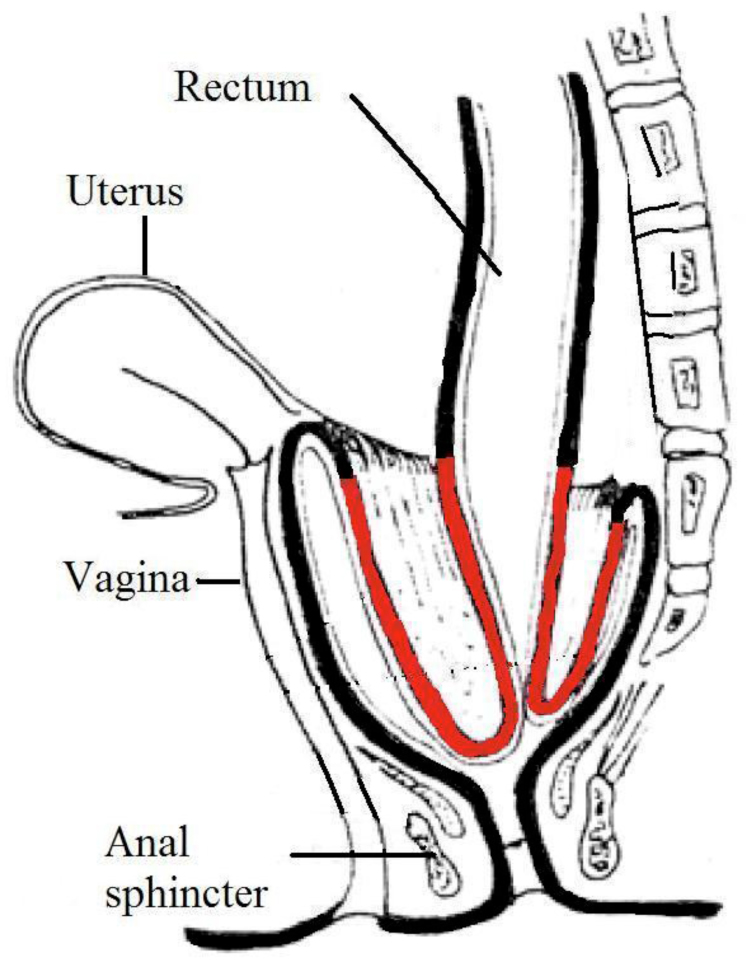 Diagram showing the rectal wall prolapsing on itself internally. This can progress to an external prolapse